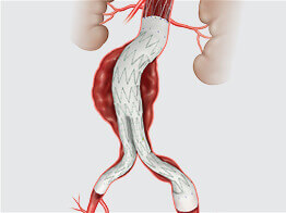 Image of Aortic Intervention