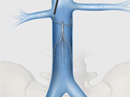 Image of Peripheral Intervention