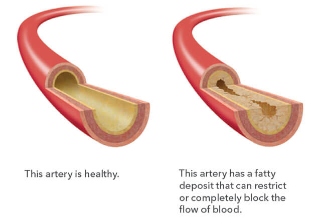 Diseased artery