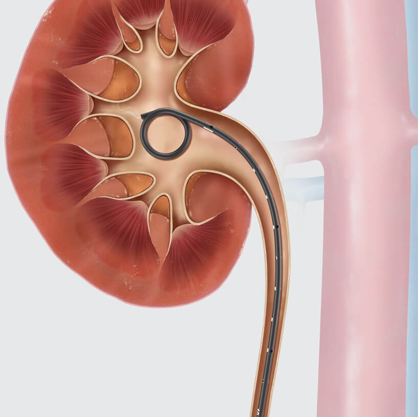 Urology Contracting Cook Medical