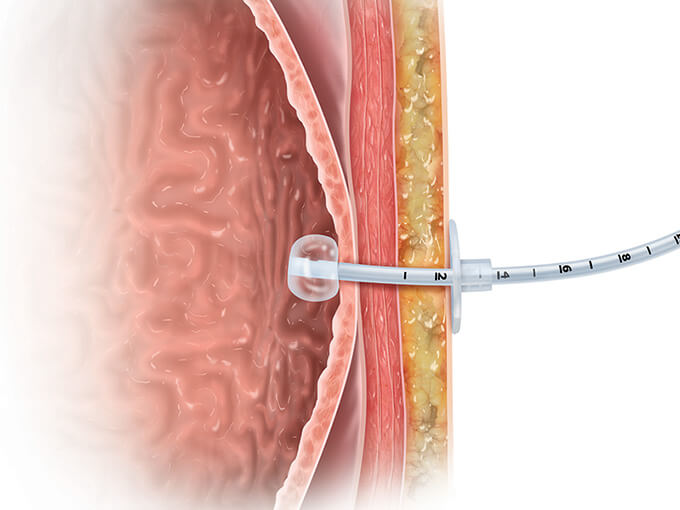 Understanding your feeding tube