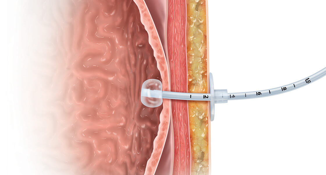 What is a gastrostomy tube or “G-tube”?