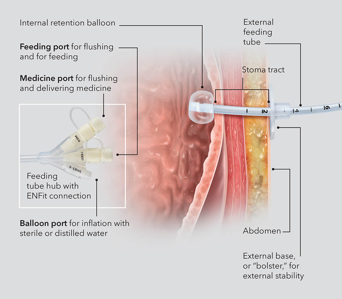 What is a balloon retention gastrostomy tube?