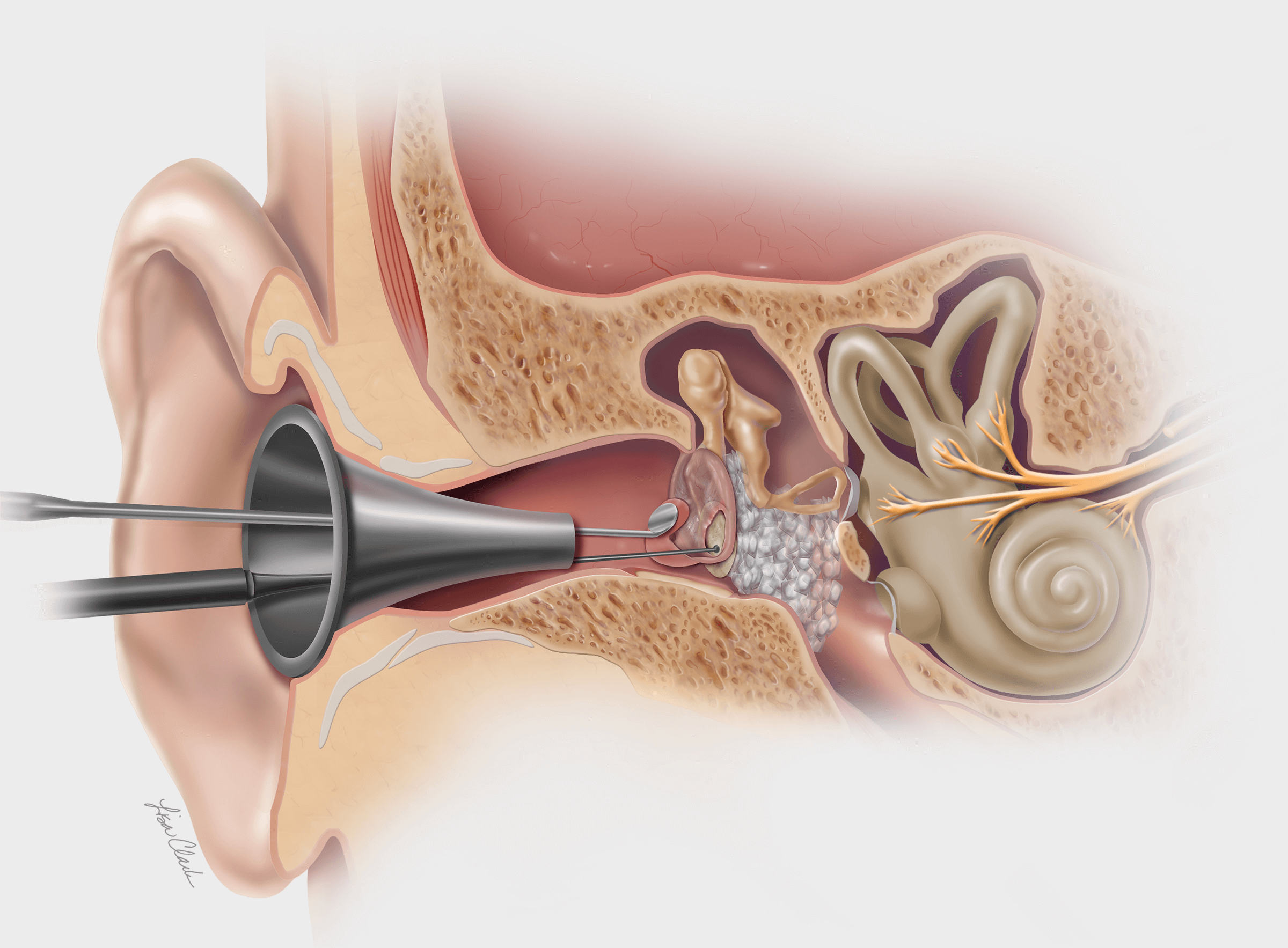 Tympanic Membrane Perforation Repair Unit Five Tympanic Membrane Tympanic Membrane Perforation Repair Unit Five Tympanic Membrane