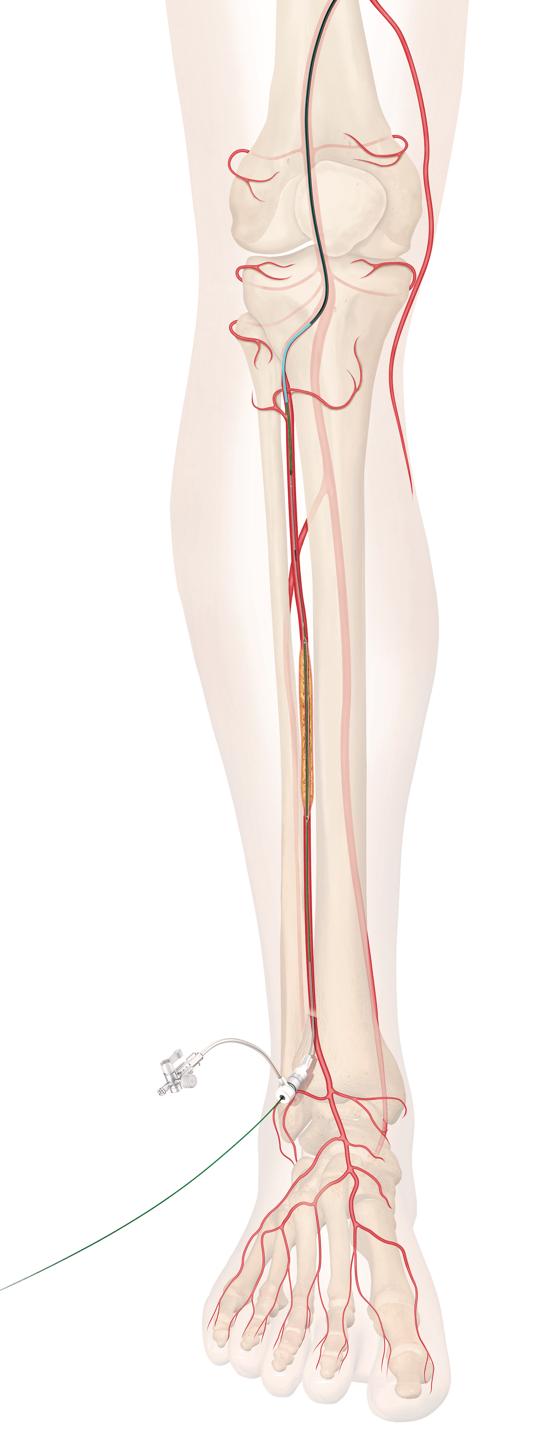 below-the-knee (BTK) stent graphic