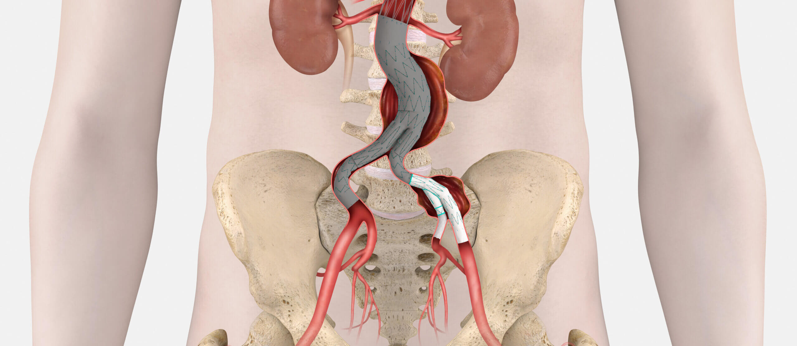 Illustration of aortic anatomy with endovascular grafts inserted, highlighting the Zenith Iliac Branch.