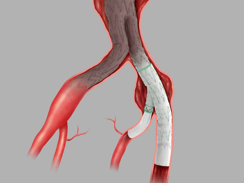 Zenith Iliac Branch device