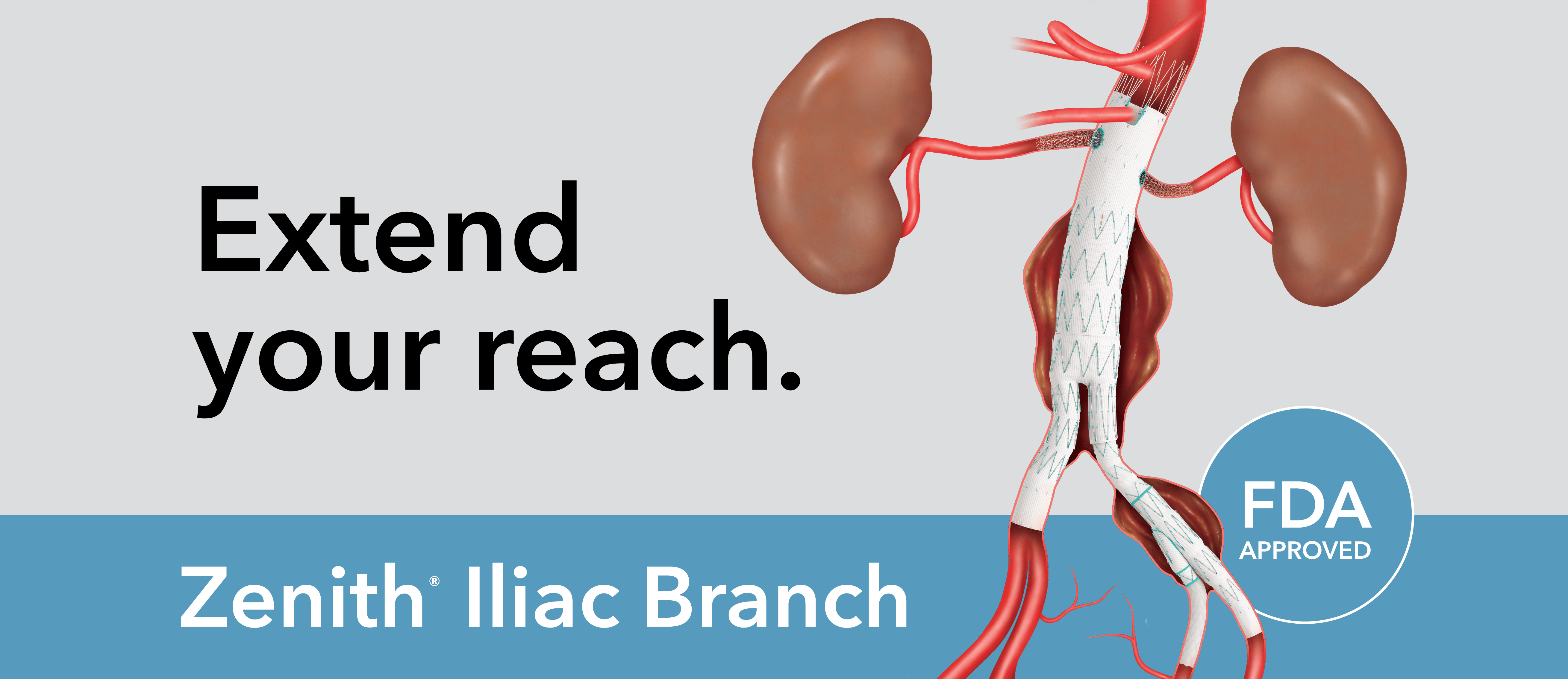 Extend your reach - Zenith Iliac Branch, designed to deliver a durable repair.
