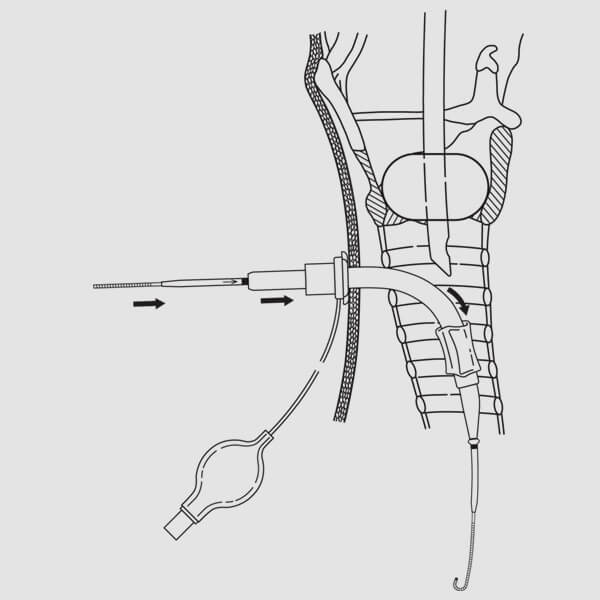 Percutaneous Tracheostomy Procedure