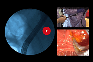 Double stenting clinical case