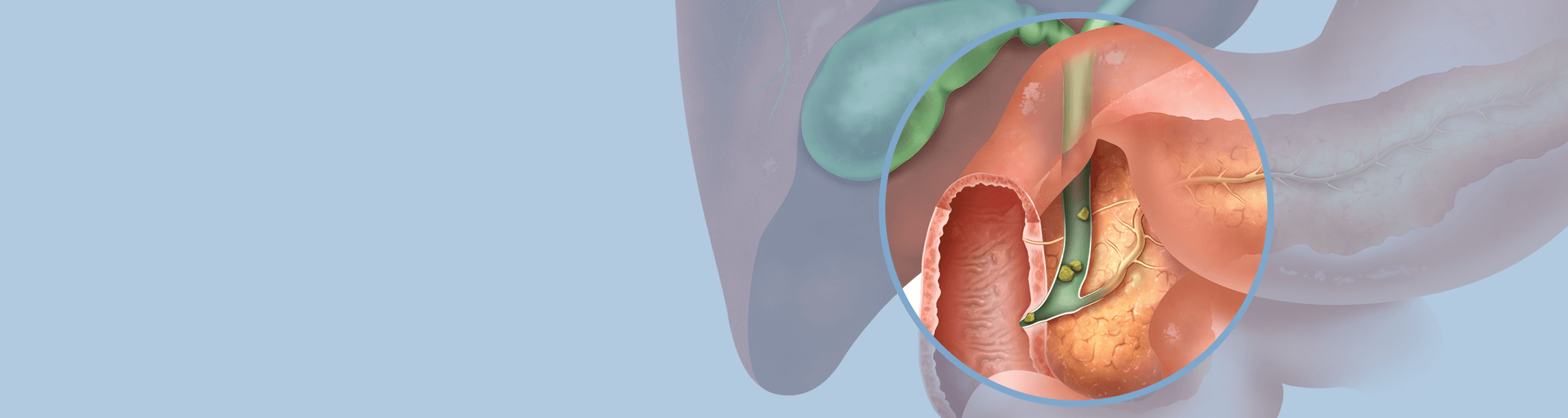 Illustration of biliary anatomy with biliary stones inside of a bile duct.