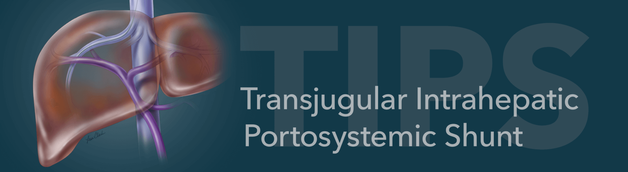Transjugular Intrahepatic Portosystemic Shunt
